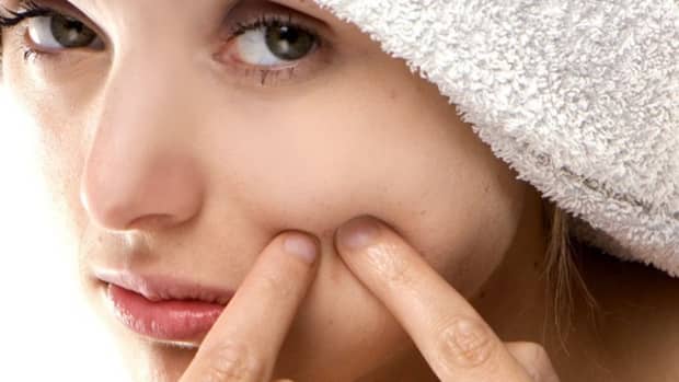 blackheads-and-how-to-get-clear-skin