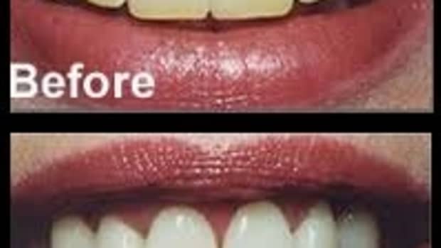 homemade-teeth-whitening
